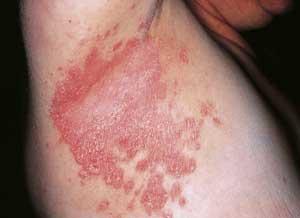 Las drogas y la psoriasis